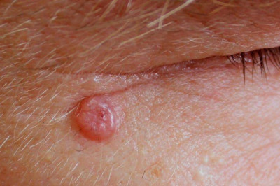 Cáncer Basocelular