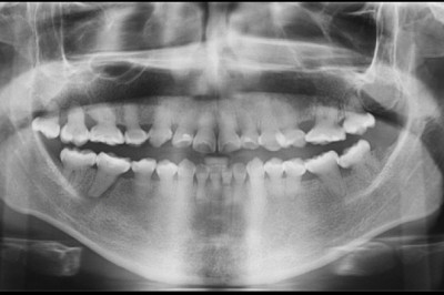 AMELOGÉNESIS IMPERFECTA