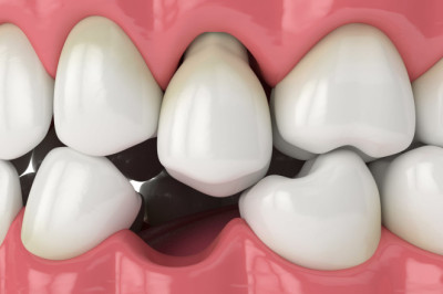 Consecuencias de la pérdida de un diente