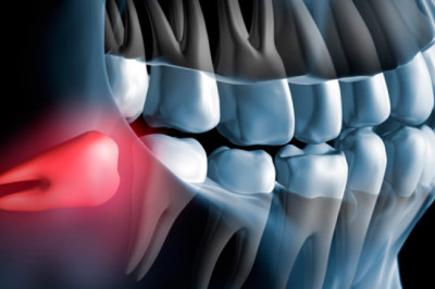 Extracción de cordales 🦷