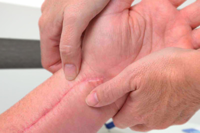 Disminuye hasta el 80% de las Cicatrices
