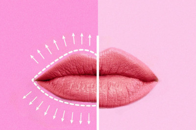 Aumento de labios 💋