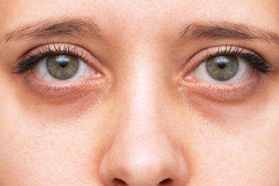 ¿Sabías qué? Las ojeras se vuelven más frecuentes a medida que envejecemos 👁️