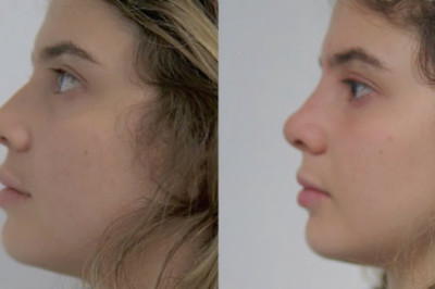 ¿Quieres una nariz perfecta sin necesidad de realizarte una cirugía?