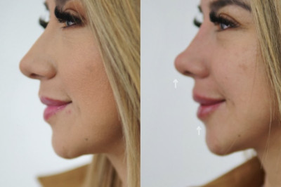 ¿Sabías qué con la perfiloplastia tu rostro queda totalmente proporcionado?