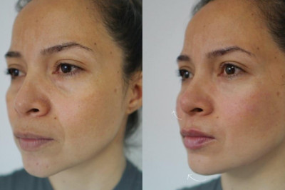 Perfil más definido sin pasar por el quirófano