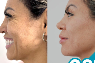 20% off en aplicación de toxina botulínica