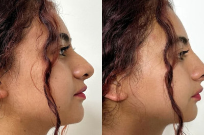 ¡Mira la transformación increíble con la Rinoredux!  💚