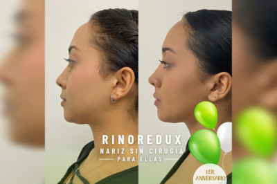 ✨ Descubre el poder de la Rinoredux  (Nariz sin cirugía) ✨