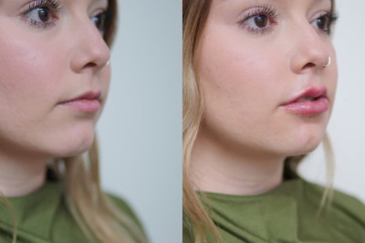 ✨ Luce unos labios perfectos con nuestro tratamiento de relleno! 💋a