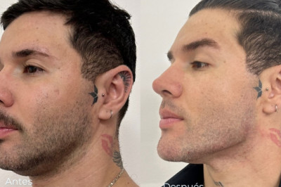 La masculinización facial