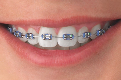 Todo lo que debes saber sobre los brackets y su importancia para una sonrisa saludable
