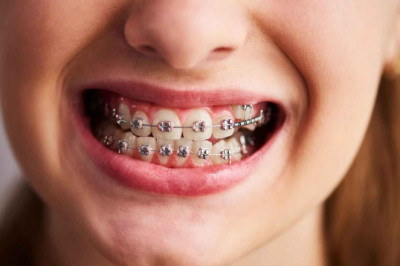 😁 Brackets a los 40: ¡Y por qué no!